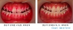 전문가 양치교육(Tooth Pick Technique)전후로 달라진 치아의 치태양상