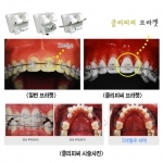 통증이 적고 스마트한 ‘클리피씨’ 교정