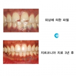 지르코니아 치료 전후