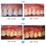 잇몸 이식 후의 사진