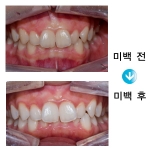 치아와 잇몸 미백은 이제 필수