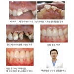 뼈 속까지 부러진 치아, 골내 치아이식술로 살려보자