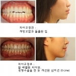 치아교정만으로 변화된 치아배열과 아름다운 심미선