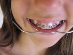 교정을 하면 치아가 약해진다?…치아교정에 관한 잘못된 상식