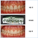 루덴치과, 라미네이트 3분의 1 비용의 라미세라 선보여