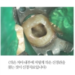 CT 및 현미경을 이용한 신경치료 및 치근단 수술