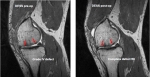 카티필(CartiFill, 연골조직수복용 콜라겐 필러)을 이용한 심각한 무릎연골 결손치료 전후의 연골조직 상태(붉은 화살표 지시 부분)를 자기공명영상(MRI)으로 촬영한 모습.  