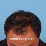 정수리탈모 치료전
