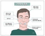 나이가 몇인데 … 젊은 층 구안와사(안면신경마비) 이유는?