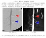 혈관 조영 영상과 MRI 영상 비교 (다나까 귀금속공업 등에 의한 ‘비자성 합금을 이용한 뇌동맥류용 색전 치료 코일 개발’)
