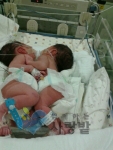 샴쌍둥이 씩씩이와 다정이, 심장분리수술 시급…수술비 없어 안따까워