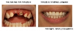 깨지고 부러진 치아를 위한, 간단한 치아성형치료 전후사진