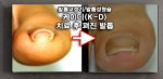 케이디 치료 후 펴진 발톱 모양