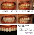 치아성형, 라미네이트, 치아미백, 잇몸성형 시술 직후 가지런하고 깨끗해진 치아와 잇몸의 모습.