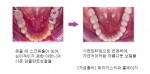 스크류 홀이 보이는 임플란트 보철물을 자연치아와 같이 변경한 모습