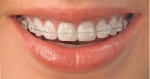 치아교정을 통해 충치, 잇몸병 등 구강건강을 예방할 수 있다.