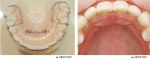 치아교정 유지장치에는 가철식유지장치와 고정식유지장치가 있다.