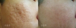 여드름으로 함몰된 흉터는 해당 부위 진피층에 이산화탄소가스와 히알루론산을 순차적으로 주입하여 새로운 콜라겐 조직을 자생적으로 만들면 쉽게 치료할 수 있다.
