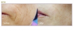 심한 팔자주름 간단한 치료법 자가진피회생술