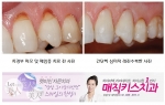 치경부 마모증을 레진을 이용한 심미적으로 치료한 전후사진