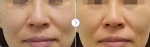 레블라이트토닝은 가우시안 모드의 엔디야그 출력방식을 보완한 레이저로 진피 아래쪽에서부터 올라오는 멜라닌색소를 차단하는 방법이다.