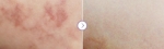 기미치료 방법에는 레블라이트 토닝, 이토닝, PRP, 물광주사 등이 있다.