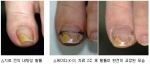 케이디 치료는 2003년도부터 4년간 임상 시험을 진행하면서 형상기억합금의 두께를 측정하고 발톱의 사이즈별로 최적화했다.