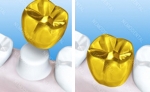 치과 보철물 종류에 따라 사용되는 순금함량은 다르다. 흔히 금니라고 부르는 골드크라운은 순금 함량이 46% 이상, P.F.G크라운과 P.F.G브릿지 순금 함량이 80% 이상의 수치