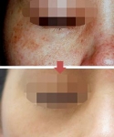 기미를 고민하는 여성들이 많지만 하나하나 따져보면 기미 하나만이 아닌 복합적인 피부 문제를 갖고 있는 경우가 많다.