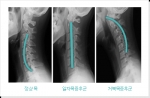 일자목증후군이 젊은층에서 크게 늘고있다.