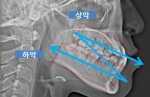 화이트치과 Zoom in 양악 엑스레이 모습