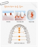 충치는 치아 사이, 치아와 잇몸 사이, 치아 안쪽, 어금니 윗면 등 양치질이 잘 안 되는 부위에 잘 발생한다.
