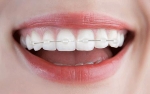 ‘앞니교정’은 앞니 배열상태, 나이, 성별, 건강상태에 따라 3~6개월의 단기간에 아름다운 치아라인을 완성할 수 있다는 장점이 있다.