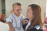 국제구호NGO 함께하는 사랑밭이 한국으로 초청해 수술을 지원한 미얀마 화상아동 아웅툰울(24개월)이 지난 5일, 한강수병원에서 수술을 받았다