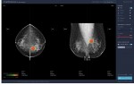 식품의약품안전처 허가를 받은 유방암 진단 보조 소프트웨어 ‘루닛 인사이트 MMG’ 온라인 데모 웹사이트 화면