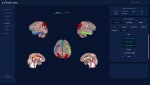 ATROSCAN의 뇌 MR 영상 분석 화면