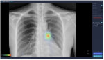 루닛의 폐 질환 진단 보조 AI 소프트웨어인 ‘루닛 인사이트 CXR’. 인공지능을 활용해 흉부 엑스레이의 비정상 소견을 표시한다