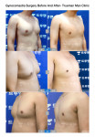 Trueman Man Clinic Network Demonstrates Its Excellence in Gynecomastia Surgery in Korea with 25,700 Operations