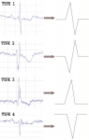 실험대상군이 보여준 4가지 유형의 파형 비교