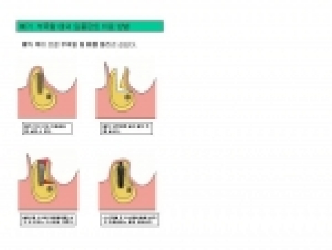 뼈가 적어 임플란트를 이식 할 수 없을때 시술 하는 바이콘 임플란트 시술 도안