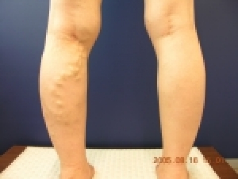 하지정맥류 증상의 예시(무단복제 금지)