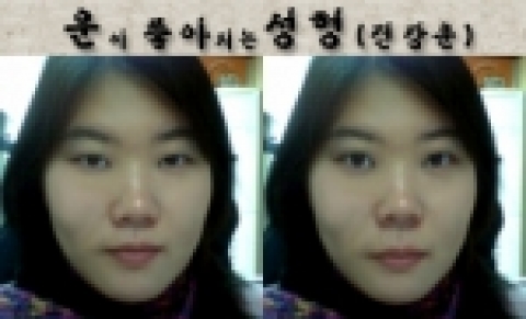 건강운이 좋아지는 성형의 예