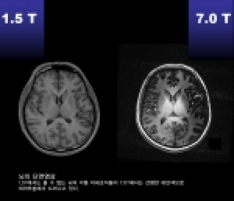 초고해상도 MRI(7.0T)의 뇌 속 사진