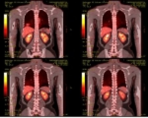 연구소에서 직접 생산한 FDG를 이용한 PET-CT 촬영 영상