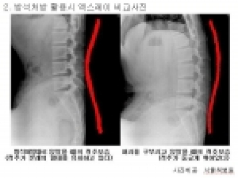 방석처방대로 앉았을 때와 허리를 구부리고 그냥 앉았을 때의 척추 엑스레이 비교사진