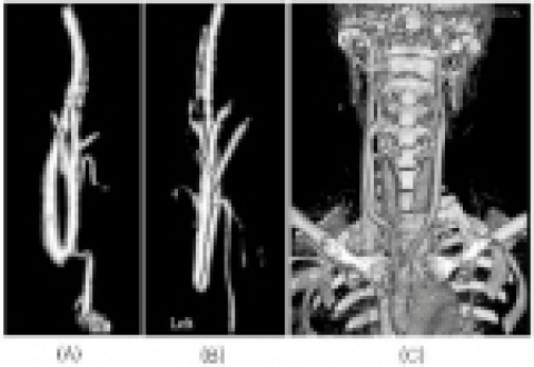  (사진 A 와 B) 수술전 CT 조영술 : 양측 총경도맥이 막혀있다. (사진C) 수술 후 CT 조영술 : 상행대동맥과 양측 경동맥 사이에 Y자형의 인공혈관을 이용하여 내경동맥으로