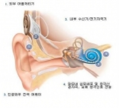 인공와우장치의 개략도