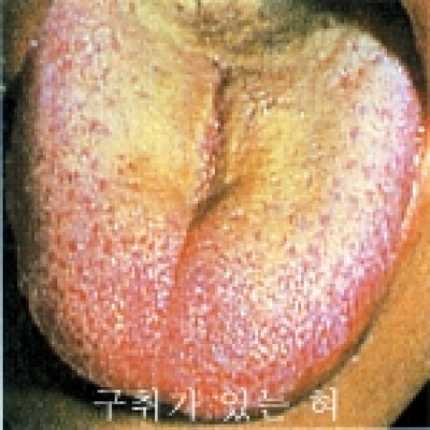 구취가 있는 혀 사진