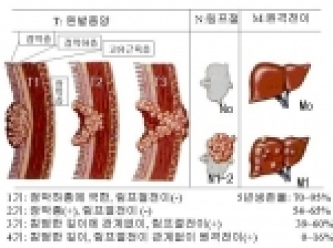 서구식 식생활, 급증하는 대장암