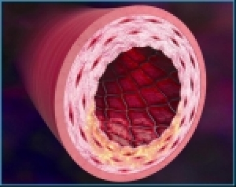 혈관속에 삽입된 엔데버 약물방출스텐트